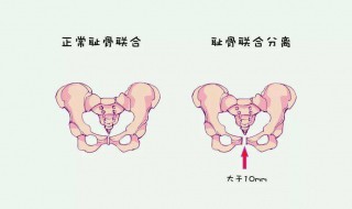 耻骨在哪个位置（耻骨在哪个位置的图片 孕妇孕中期耻骨疼）