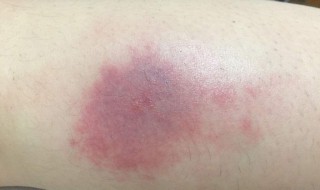 蚊子咬了红肿怎么止痒 被蚊子咬了红肿怎么止痒