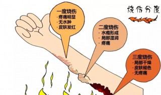 烧伤怎么处理好的快 严重烧伤怎么治好的比较快