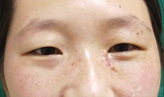 眼角有痣代表什么（眼角有痣代表什么意思）