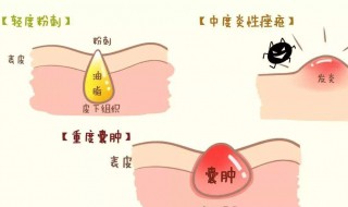 怎样处理青春痘（怎样处理青春痘痘）