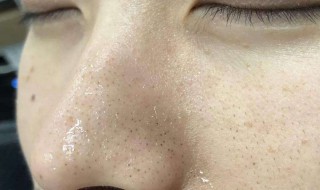 去黑头的小窍门（如何去除黑头）