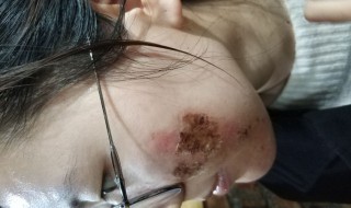 水痘坑的修复方法（水痘坑的修复方法有哪些）