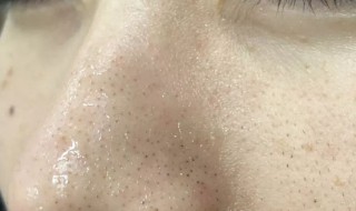 怎样去鼻子黑头（鼻子有黑头怎么去除最有效）