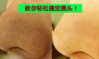 清理黑头最有效的方法（清理黑头最好的方法）
