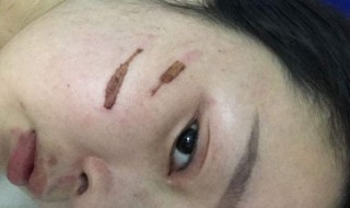 去疤去印的方法 去疤去印的方法图片