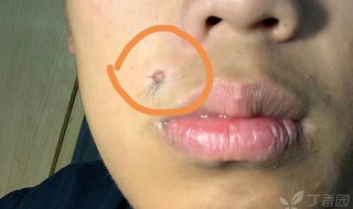 脸上哪些痣不能去掉 女生脸上哪些痣不能去掉