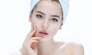 天然去痘印方法 天然去痘印方法图片