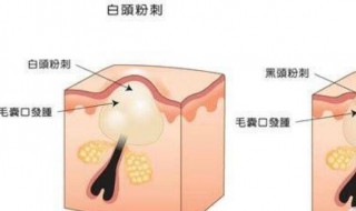 脸上粉刺闭口怎样消除 脸上粉刺闭口怎样消除掉